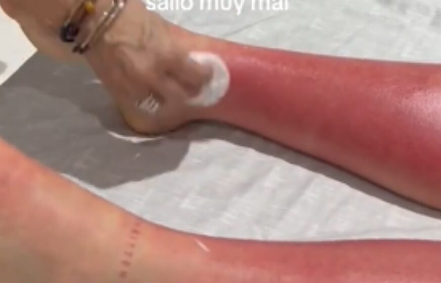 (VIDEO) KADA JE SHVATILA VEĆ JE BILA U BOLNICI Djevojka uživala na suncu, nije ni slutila kakvu je grešku napravila