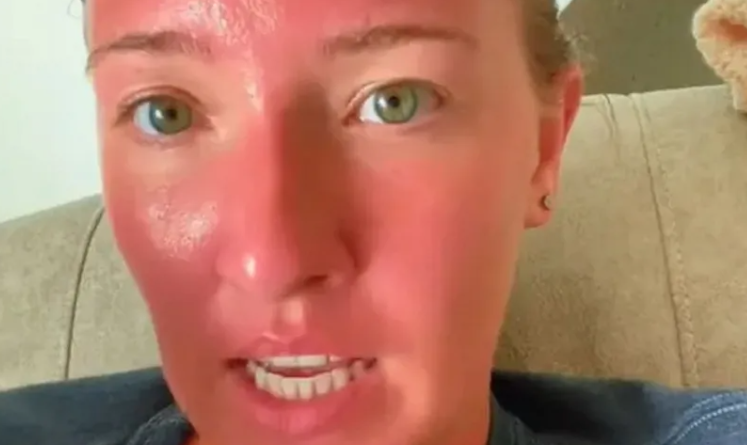 (VIDEO) "Ovo je opekotina koja mijenja život" Helen 2 sata zaspala na plaži na suncu, sada se boji za sopstveni život