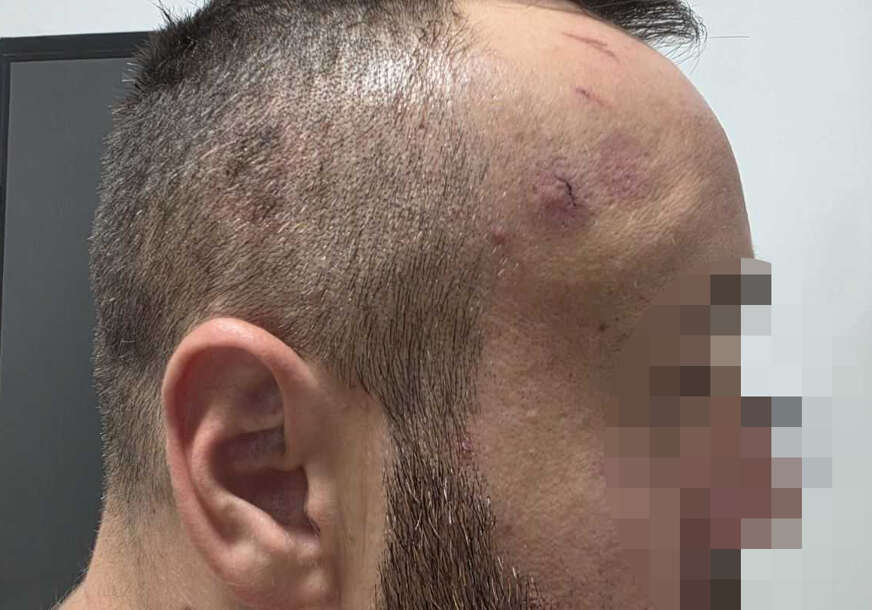 (FOTO) Prva zvanična izjava žrtve POLICIJSKE BRUTALNOSTI u Banjaluci "Tukli su me u haustoru, stavili nogu na vrat i rekli ‘ovo je tek početak’“