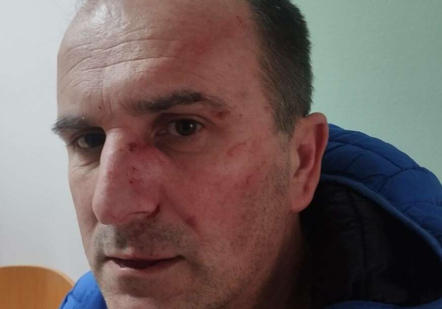 (FOTO) Završio u bolnici: Aktivista SDS BRUTALNO PRETUČEN jer je otkrio OVO