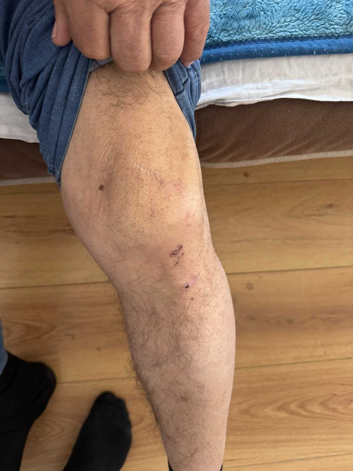 Policijska brutalnost, povrede