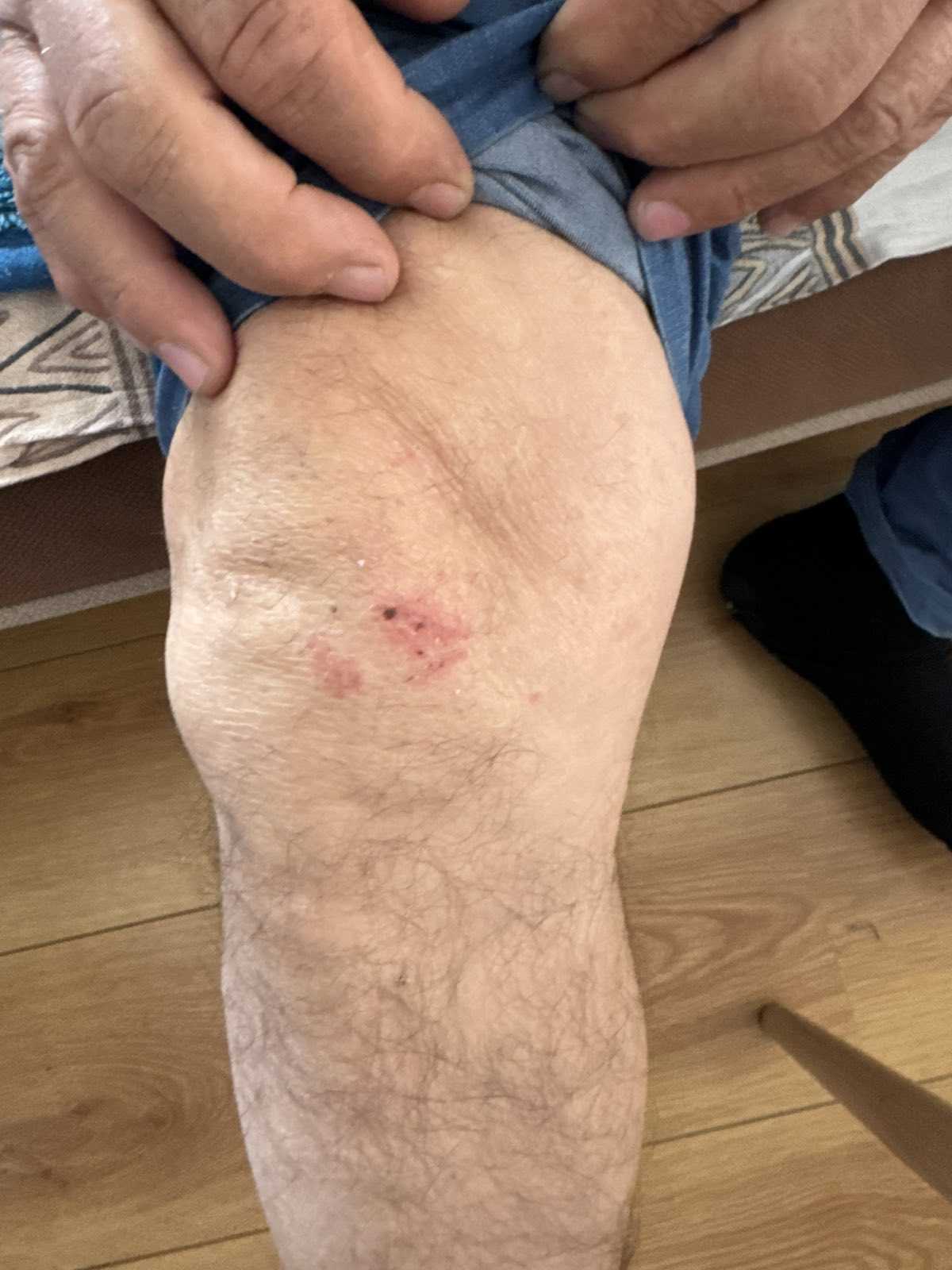 Policijska brutalnost, povrede