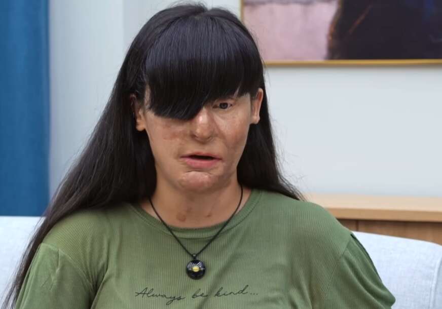 (FOTO) "Ako ne možeš biti moja, nećeš biti ničija" Zbog raskida POLIO DJEVOJKU KISELINOM i unakazio joj lice, a ona se nakon što je izašao iz zatvora UDALA ZA NJEGA