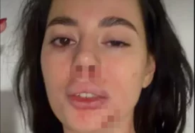 (FOTO) "DJEVOJKE, PAZITE SE" Bivša rijaliti učesnica objavila jezive fotografije, cijela je u modricama