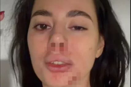 (FOTO) "DJEVOJKE, PAZITE SE" Bivša rijaliti učesnica objavila jezive fotografije, cijela je u modricama