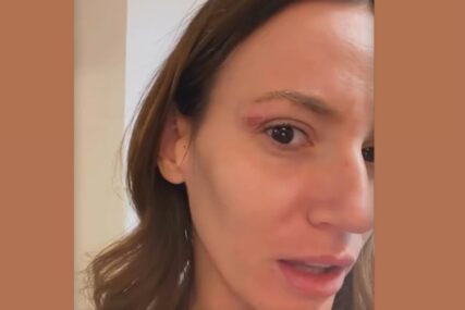 (FOTO) "MAMINI GENI" Kristina Spalević sva u ranama, pokazala modricu na licu