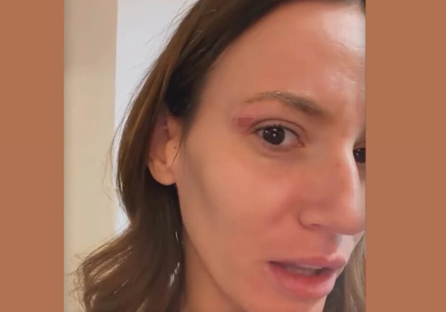 (FOTO) "MAMINI GENI" Kristina Spalević sva u ranama, pokazala modricu na licu
