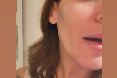 (FOTO) “MAMINI GENI” Kristina Spalević sva u ranama, pokazala modricu na licu